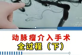 动脉瘤介入手术全过程（下） #神经外科 #动脉瘤 #介入手术 #医学科普 #硬核健康科普行动视频封面
