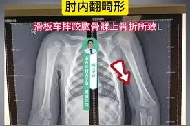 肘内翻畸形 两岁孩子玩滑板车摔倒导致肱骨髁上骨折，当地没有拍片，直接打了个石膏，一个月后发现严重肘内翻，两年后越发严重。#肘内翻 #肱骨髁上骨折  儿童肱骨髁上骨折是儿童最常见的肘部损伤，占肘部损伤的60%左右。对于这种骨折，正确的治疗非常重要，以避免并发症，如肘内翻。治疗时必须尽可能获得解剖复位以预防肘内翻、肘外翻或屈伸活动丧失。 肘内翻的原因：肘内翻畸形通常出现在肘关节周围骨折患者中，尤其是肱骨髁上骨折的患者，出现肘内翻畸形占整个肘内翻患者的80%以上。肘内翻可能是由于骨折复位不良或骺板损伤导致内外生长速度不一样所致。 肘内翻的后果：肘内翻不仅影响外观，还可能增加继发肘关节骨折的风险，有时还会影响肘关节的屈伸活动。严重时，可能需要手术治疗，以纠正畸形并恢复功能。 治疗建议：对于已经发生的肘内翻，轻度的早期可以采取保守治疗，如手法外翻训练、石膏固定矫形和支具活动矫形。对于严重或持续进展的肘内翻，可能需要手术治疗，如外侧闭合楔形截骨或倒“V”式截骨。 后续治疗：鉴于孩子的情况已经发展到两年后越发严重，建议尽快咨询专业的儿童骨科医生，进行详细的评估和必要的影像学检查（如X光片），以确定肘内翻的严重程度和最佳治疗方案。可能需要通过手术来纠正肘内翻，以避免进一步的并发症和功能障碍。视频封面