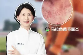 盛夏时节汗不断，当心马拉色菌来烦扰 #马拉色菌 #马拉色菌毛囊炎 #健身 #太热了