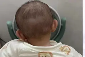 宝宝总歪头可能是斜颈！ 宝宝总歪头？可能是斜颈！斜颈分多种，可通过4大症状自查，0 - 12个月宝宝能热敷、松解、牵拉康复。治疗和预防的方法一个视频讲清楚。家长们千万别大意。#医疗健康创作训练营 #抖出健康知识宝藏#斜颈