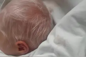 如何照顾好白化病的宝宝？#白化病 #白化病宝贝