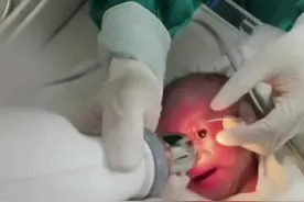 早产为什么要做这么“残忍”的眼底检查，可以筛查哪些疾病？#早产儿必须做眼底筛查吗 #早产儿应该多久进行眼底筛查 #早产儿 #医生AI分身