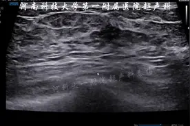 即兴分享 乳腺增生分类及意义 #超声影像 #医学科普视频封面