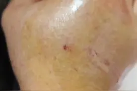 原矛头蝮咬伤 有地方问总比没地方问问好，好人一生平安#蛇类科普 #毒蛇咬伤怎么办视频封面