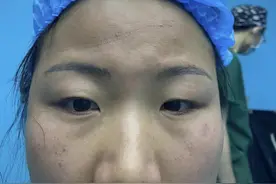11个月了#双眼皮 #做眼睛前后的对比 #眼综合真实案例 #双眼皮多久能恢复自然 #自然消肿要多长时间视频封面