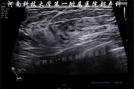即兴讲解乳腺增生、结节定位、结节声晕 #医学科普 #超声影像