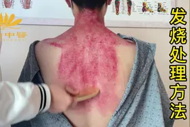 #发烧#李氏砭法刮痧 #刮痧就找徐和堂 发烧处理方法