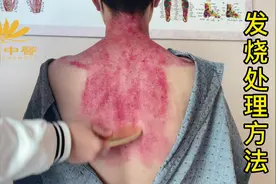 #发烧#李氏砭法刮痧 #刮痧就找徐和堂 发烧处理方法