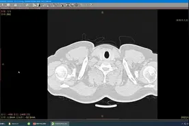 胸部CT电子档下载#肺结节 #知识分享 #健康科普 #胸部ct