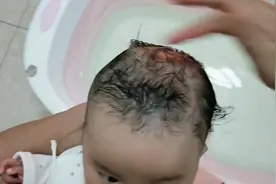 宝宝头变得有点凹凸不平妈妈担心是方颅，有知道什么原因导致的吗视频封面