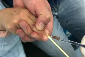 小朋友手指上有病毒疣，如何进行注射治疗？（看着都疼）视频封面