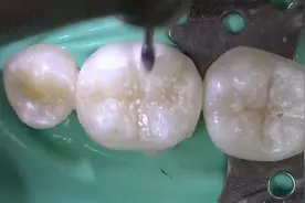 后牙树脂分层充填，遇上这样的医生补颗牙真值了。视频封面