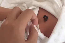 琪琪出生十一天：换尿裤把脐带蹭掉了，肚脐流血，又害怕又心慌视频封面