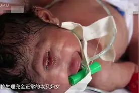 奇闻异事 天生只有一只眼睛, 医生都被吓得尖叫!_高清视频封面