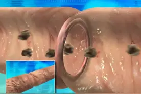 【3D动画演示】结肠切除后，吻合器连接肠管的过程及原理