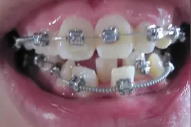 牙套矫正过程,看看牙齿神奇的变化!