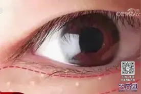 生活圈：如何去除眼部周围的汗管瘤？专家帮您支招，一起来看一下视频封面