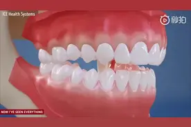 医学3D动画：牙套是如何帮助矫正牙齿的？