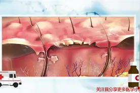 烧伤分级科普视频封面