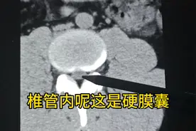 腰椎间盘CT你会看吗？医生来给您详细讲解视频封面