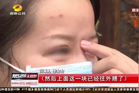 鼻梁根部一按四周翘起？女子爱美去整形，鼻子变成“跷跷板”视频封面
