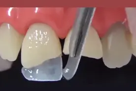 前牙断裂修复治疗过程！