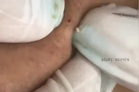 这得擦多少眼霜才能长这么多脂肪粒？都快变成小珍珠了视频封面