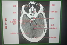 颅脑CT解剖（二）：第2层至第5层解剖识别，建议收藏视频封面