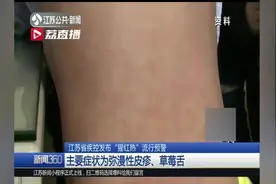江苏疾控发布“猩红热”流行预警 主要症状为弥漫性皮疹、草莓舌视频封面