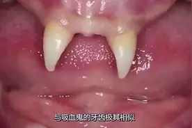 牙齿最多的人，嘴里全是牙齿，医生整整颗，拔起来好累！视频封面