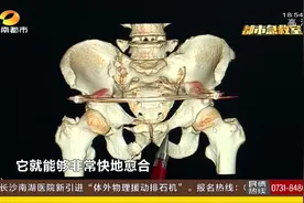 常德一民警骨盆骨折，修复难度极大，医生却打了三个小孔成功手术视频封面