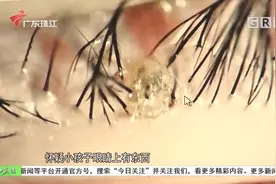 一岁女童睫毛根部有“皮屑” 显微镜下看竟是虱子视频封面