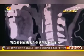 怀化67岁女子喝完蛋汤后，喉咙竟一阵刺痛，到医院一查懵了