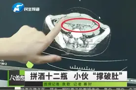 提醒 | 夏天喝啤酒要注意啦！郑州一名17岁男孩喝12瓶啤酒胃险爆炸图片