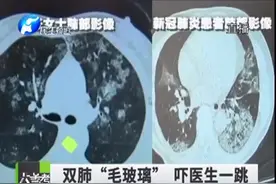 每天喷84消毒液致肺泡炎 切记稀释之后再使用，转发提醒！视频封面