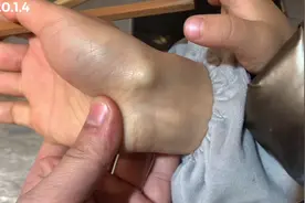 手腕上突然长了个包，摸着还有点痛，是什么东西？要去医院看吗？视频封面