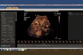 超声技术-介入及术中-超声造影-ROI造影定量操作视频封面