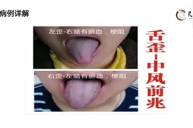 灵刺八卦舌诊案例分析：舌偏歪，应引起注意，或提示中风前兆。视频封面