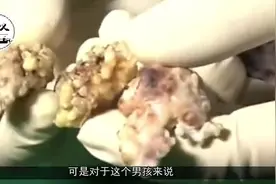 印度小伙患怪病，嘴里长满300颗牙齿，吃东西速度堪称切割机！视频封面