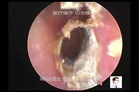 耳内镜清理耵聍、真菌，12分钟