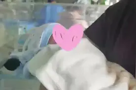 一周前成功分离的联体婴姐姐出院了 妹妹已完成心脏手术图片