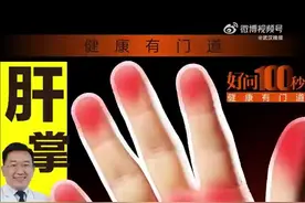 肝掌可能是肝脏问题的信号灯，出现肝掌，是肝不好了？图片