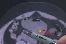 男子连吃3根生香蕉致肠梗阻图片