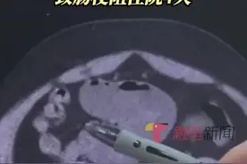男子连吃3根生香蕉致肠梗阻图片