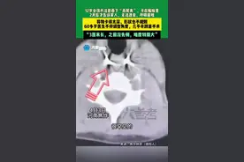 太惊险！女孩误吞燕尾夹2天不能进食才告知父母图片