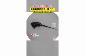 宝宝眼球被蜇进1根刺1个月才发现图片