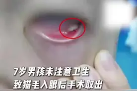 警惕！7岁男孩猫毛入眼后长肉芽手术取出图片