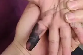 惊险！一幼童手指插充电口被烧得焦黑，电动车这个地方碰不得！图片